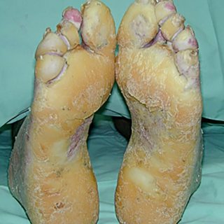 SLURP1-pEDD: diffuse transgredient palmoplantar keratoderma