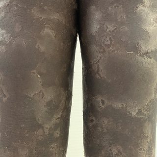 SPINK5-sEDD: linear scaly serpiginous lesions on the lower limbs