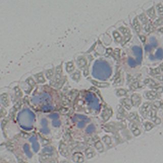ABHD5-sEDD: lipid vacuoles in neutrophils, the Jordan anomaly