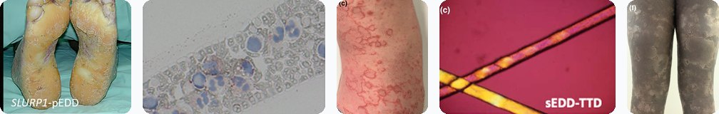 Five clinical photographs from the consensus papers: diffuse transgredient palmoplantar keratoderma (SLURP1-pEDD); lipid vacuoles in neutrophils, the Jordan anomaly (ABHD5-sEDD); pink plaques in serpiginous configurations (SPINK5-sEDD); light and dark banding of the hair shaft, tiger tail (sEDD-TTD); linear scaly lesions on the lower limbs (SPINK5-sEDD).