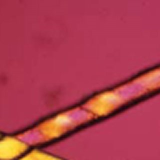 sEDD-TTD: light and dark banding of the hair shaft, tiger tail